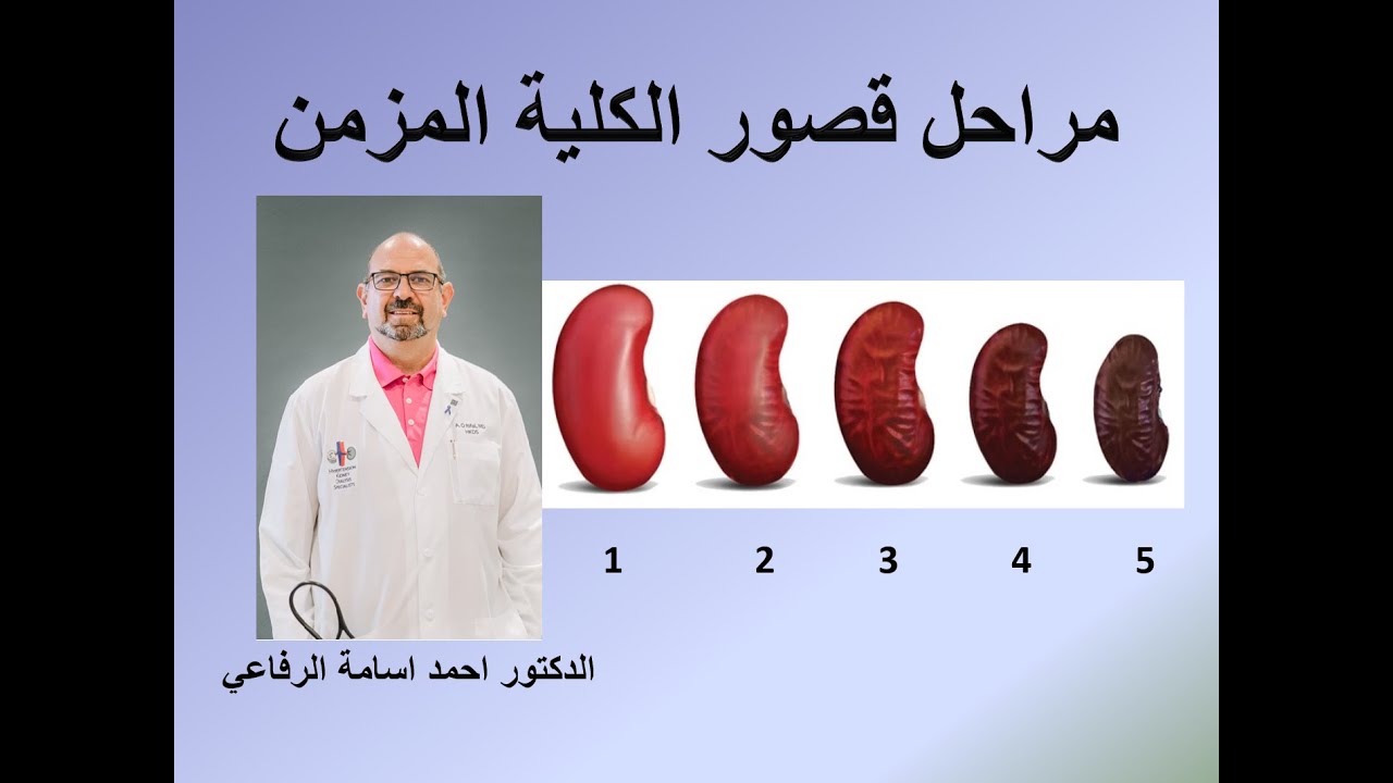 مراحل قصور الكلية المزمن         Stages of Chronic Kidney Disease