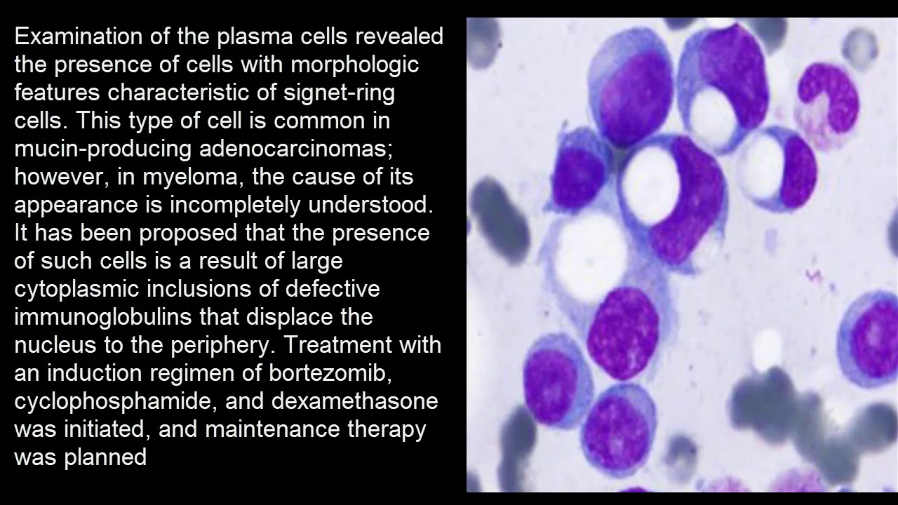 Siegelring Plasmazellen - multiples Myelom