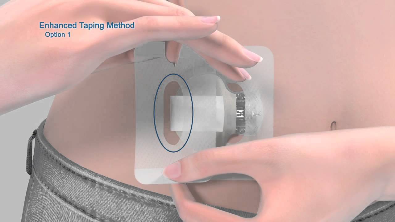 Enhanced Taping Methods for the Enlite® Sensor