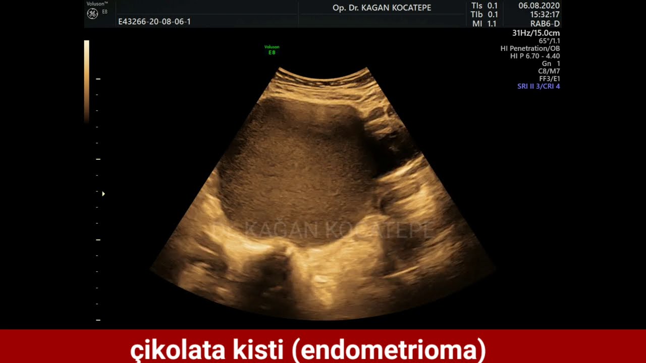 Çikolata kisti (endometrioma) ultrasonda nasıl görünür, endometriozis nedir,neden oluşur ve tedavisi