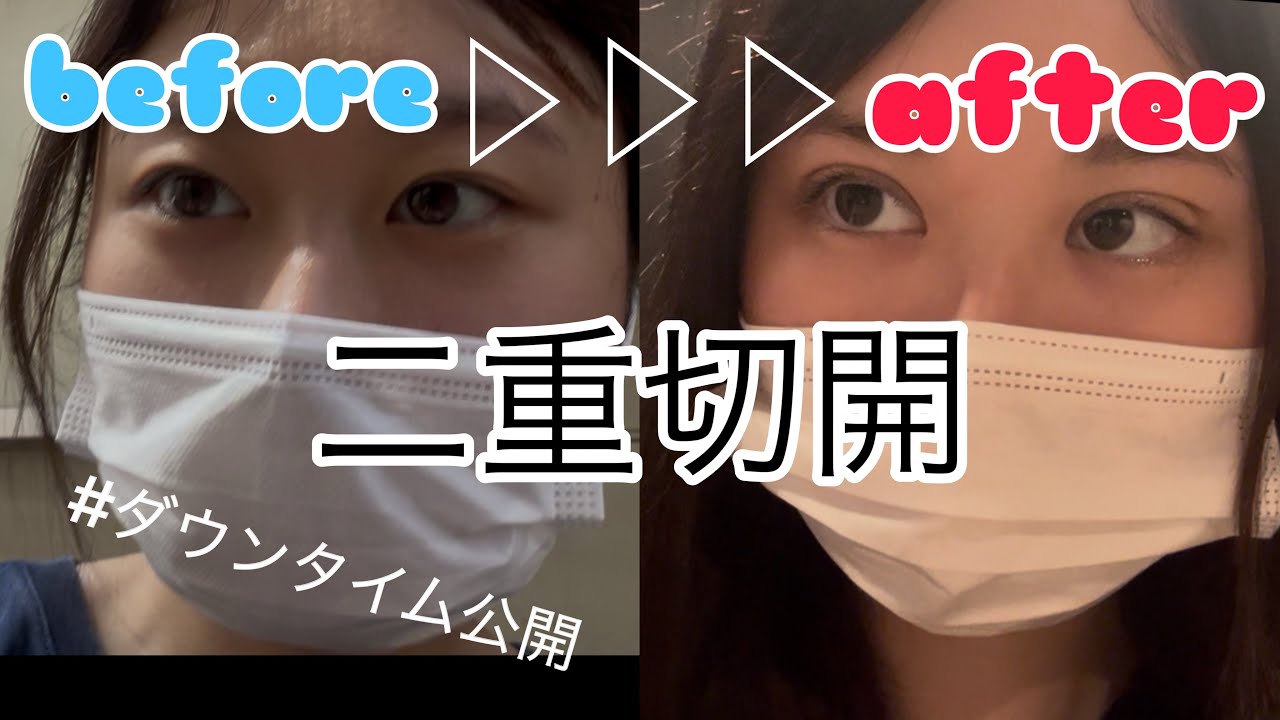 【二重切開】ダウンタイムまとめ