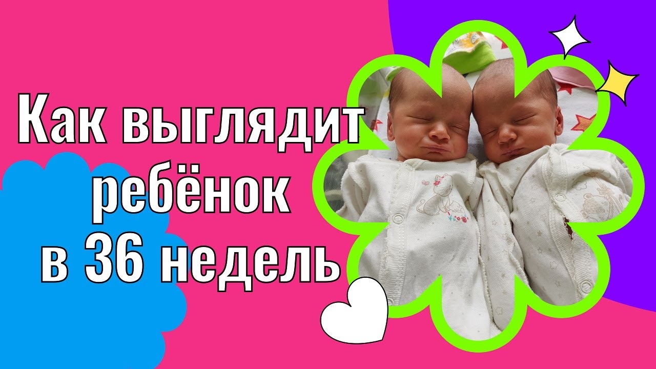Малыши в 36 недель//Монохориальная диамниотическая двойня