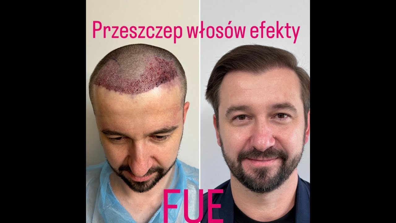 Przeszczep włosów efekty 2000 grafów.  Naturalny efekt. Transplantacja włosów Wrocław