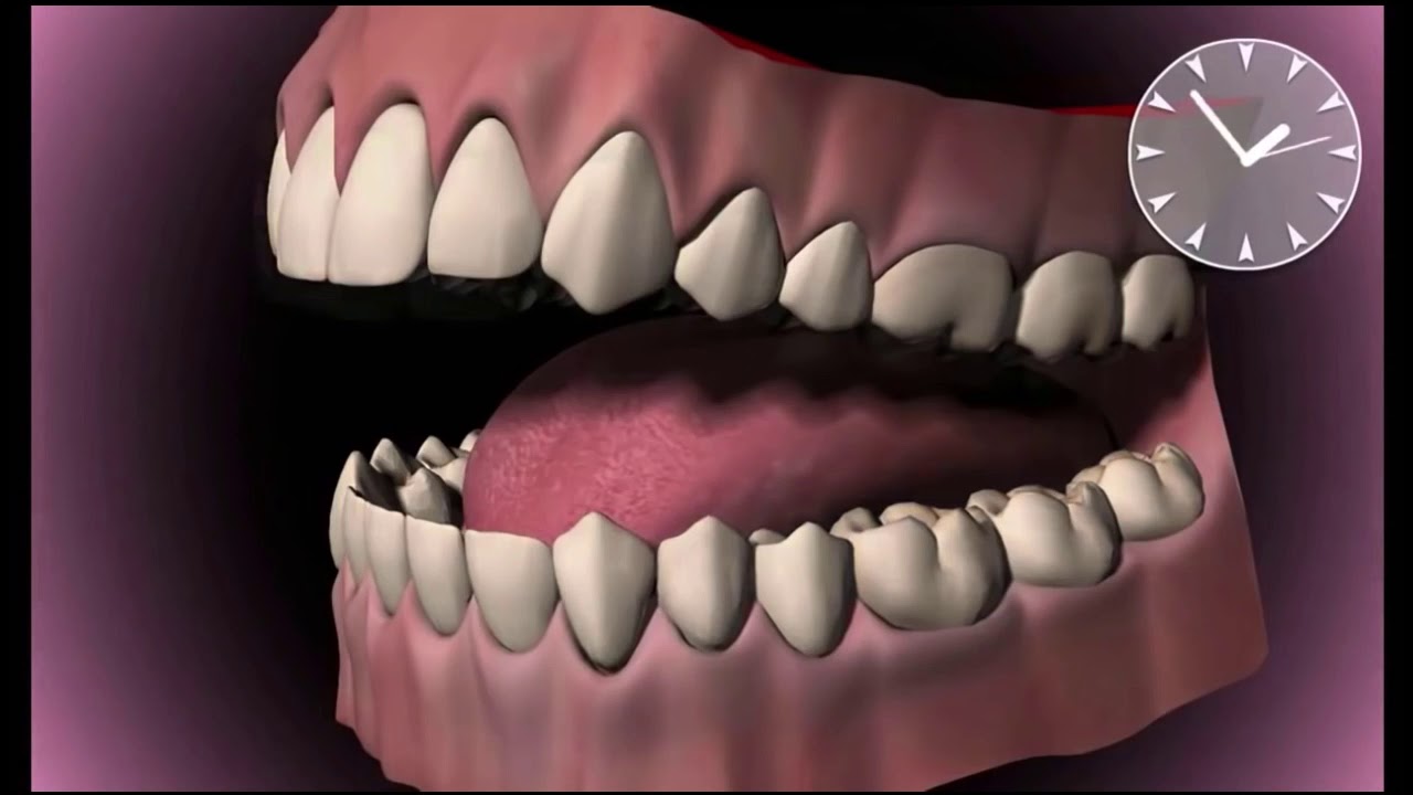 De ce se formeaza caria dentara