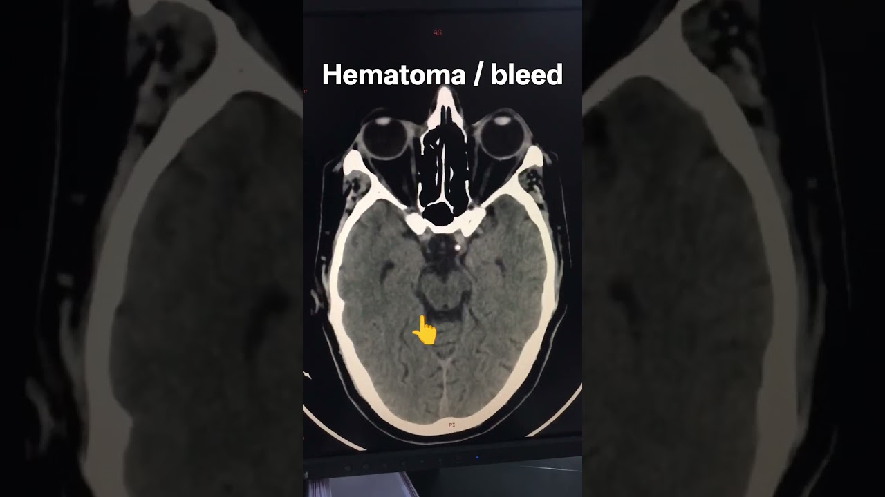 Acute hematoma involve right thalamocapsular region.#ctscan #hematoma #bleed #ct #paralysis #viral