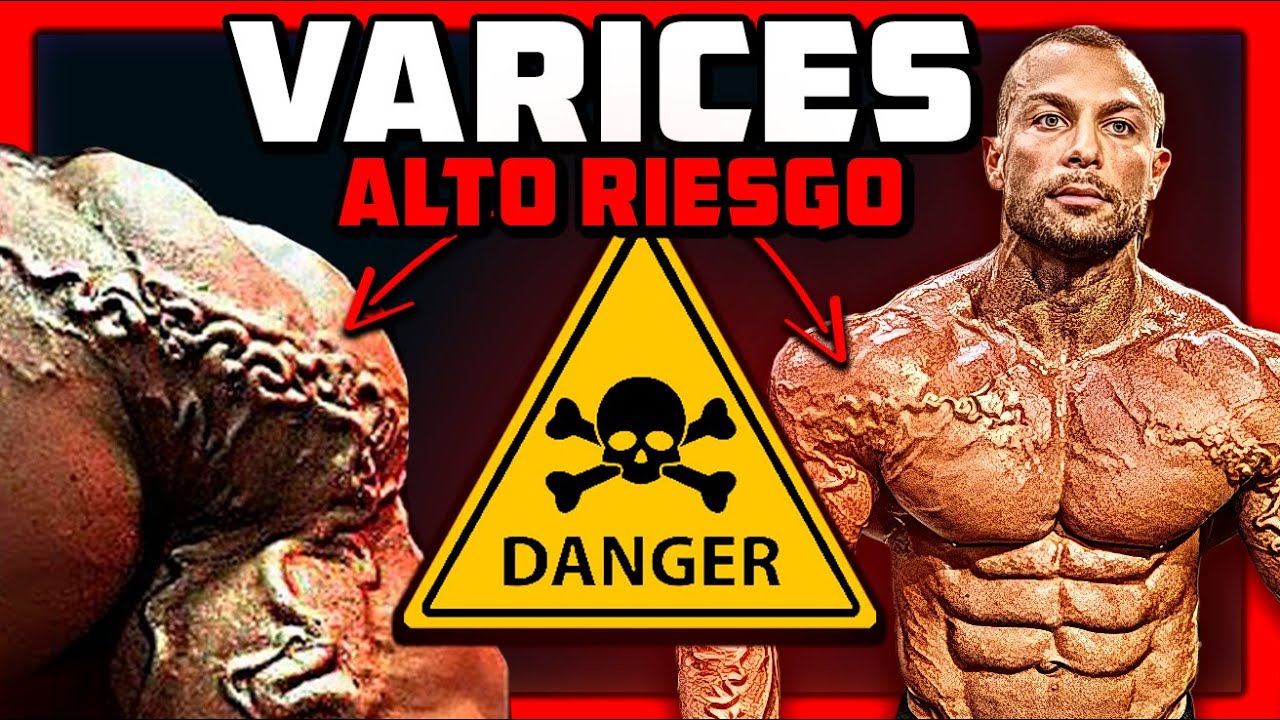 ⚠️El alto PRECIO de las Varices en el Culturismo: ¿Peligro para tu SALUD? ❤️