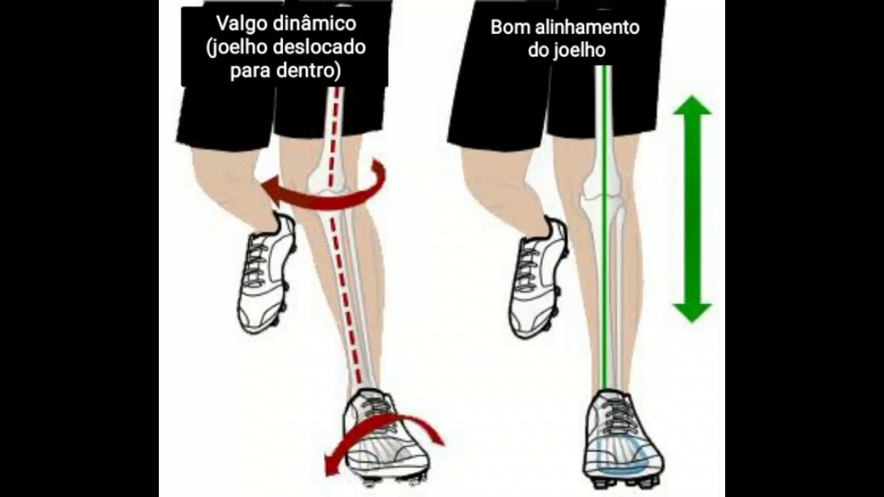 Controle motor do joelho para correção do valgo dinâmico (biofedback  by laser)