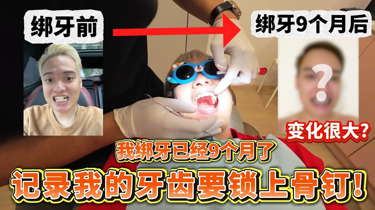 记录我的嘴巴里面要锁上一个螺丝！绑牙9个月后有很大的变化！会变瘦是因为绑牙？