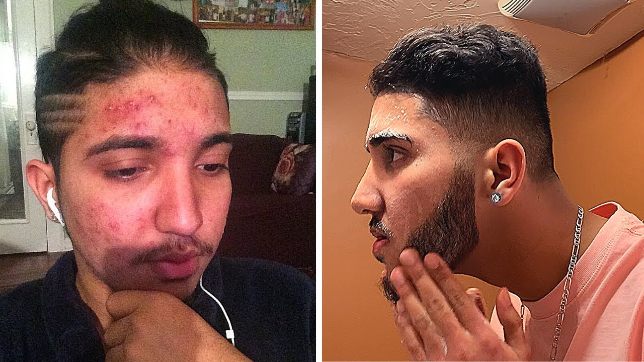 20 To Do VS 20 Not To Do To REALLY GET RID OF ACNE! *this changed my life*