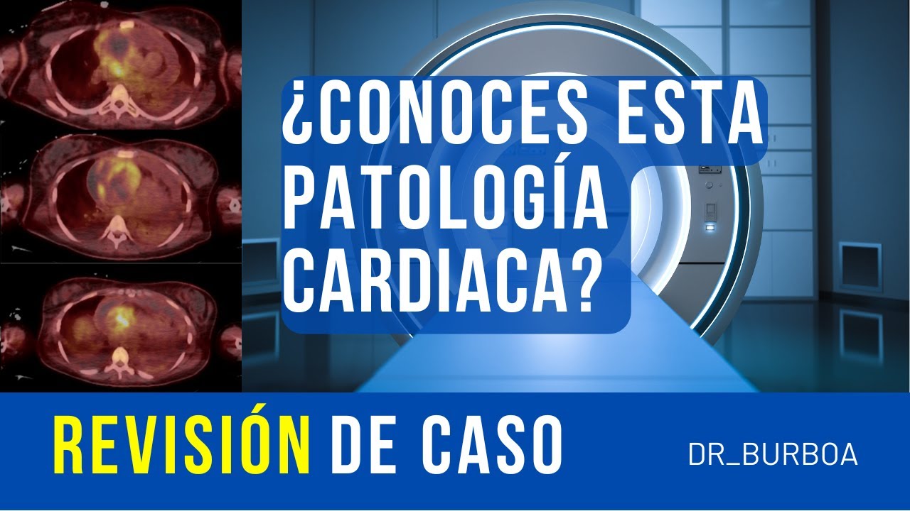 HALLAZGO INESPERADO EN EL CORAZÓN / REVISIÓN DE UN CASO / TÍA MINNIE #16