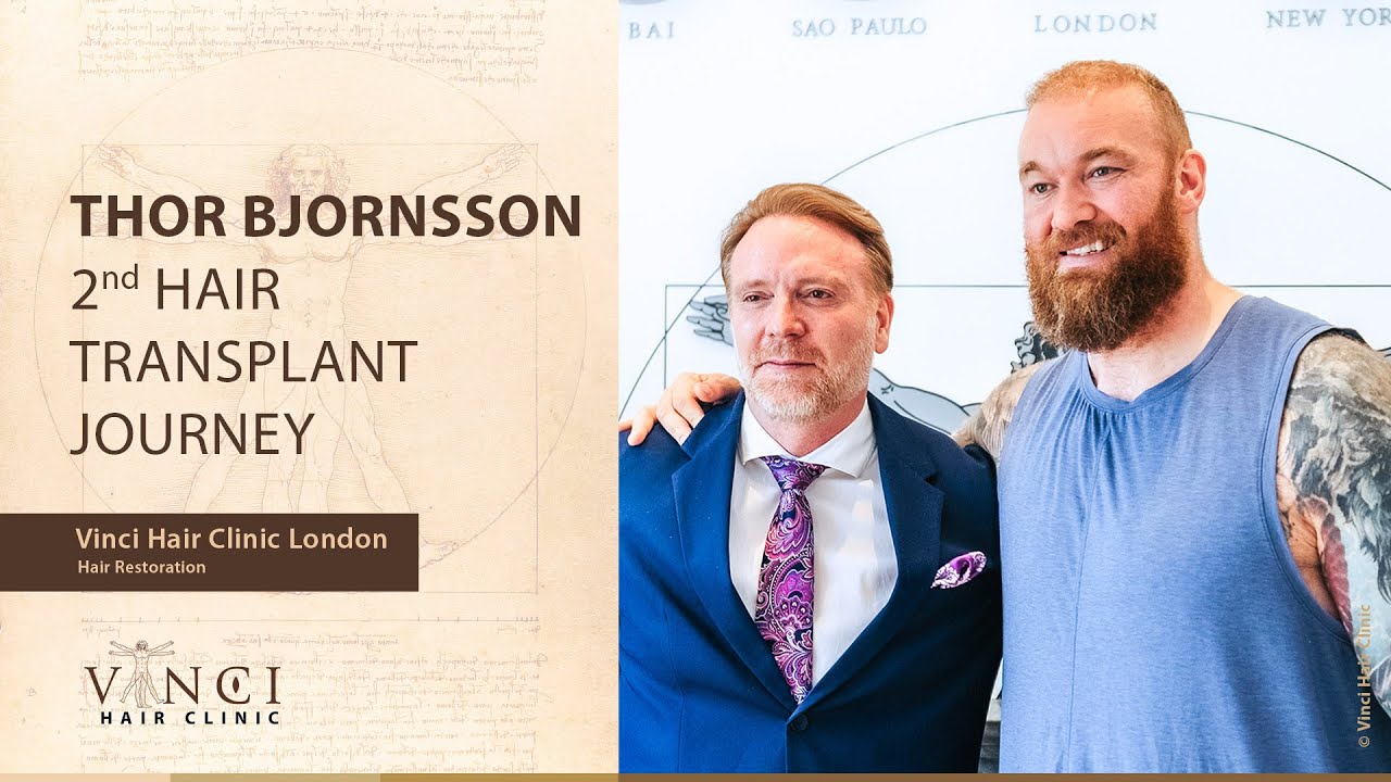 Thor Bjornsson 2nd Hair Transplant Journey with Vinci Hair Clinic London