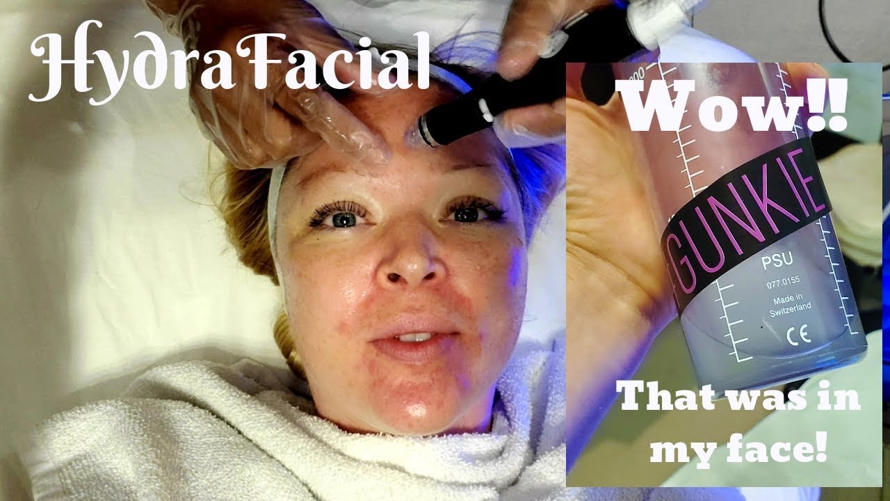 The BEST way to CLEAR acne | My First HydraFacial
