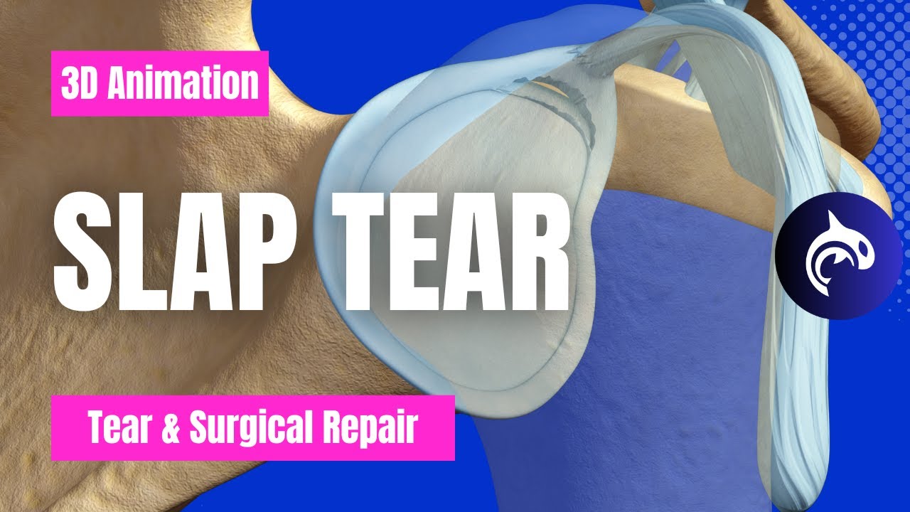 SLAP Tear and Repair - 3D Animation (No Narration)