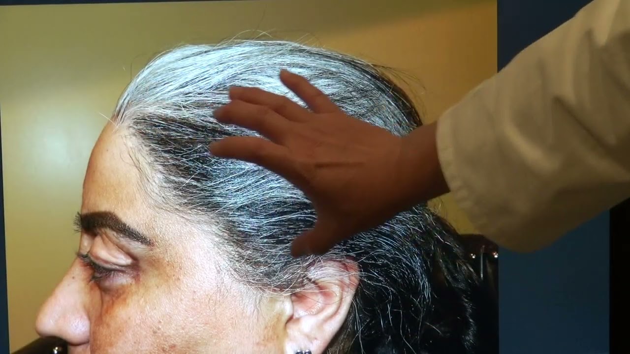 Phenomenal 1-Year Hair Transplant Results | Natural Density & Hairline Restoration