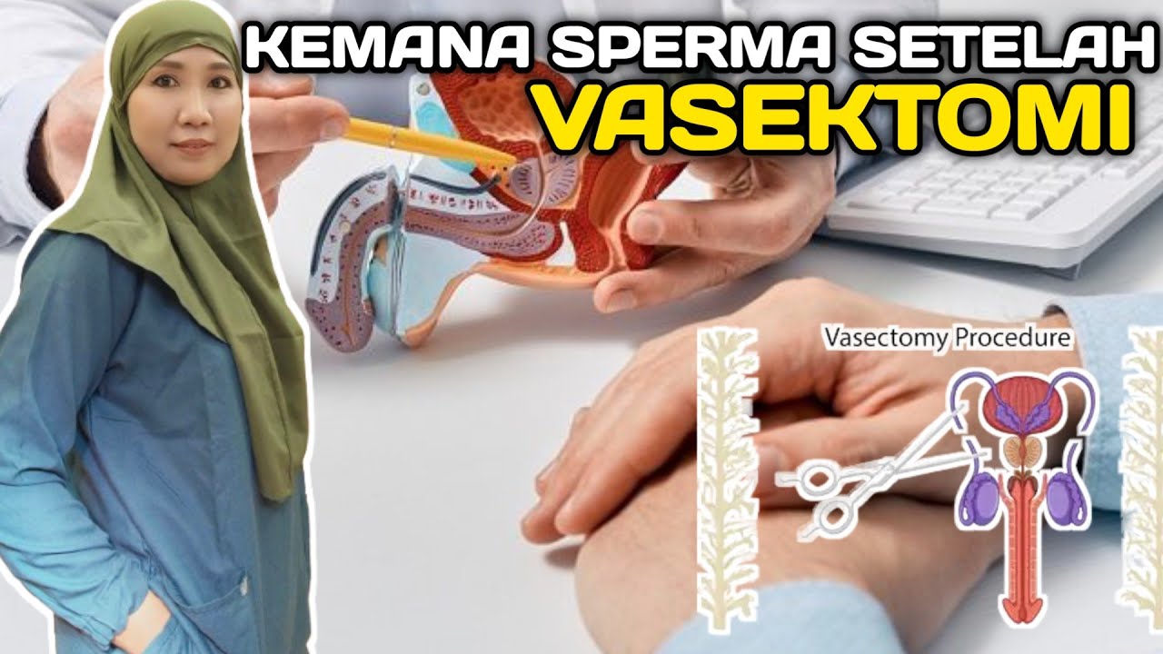 Kemana kira kira sperma setelah tindakan vasektomi