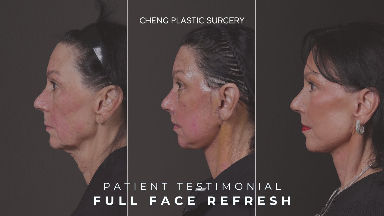 Patient Testimonial: Deep Plane Face & Neck Lift