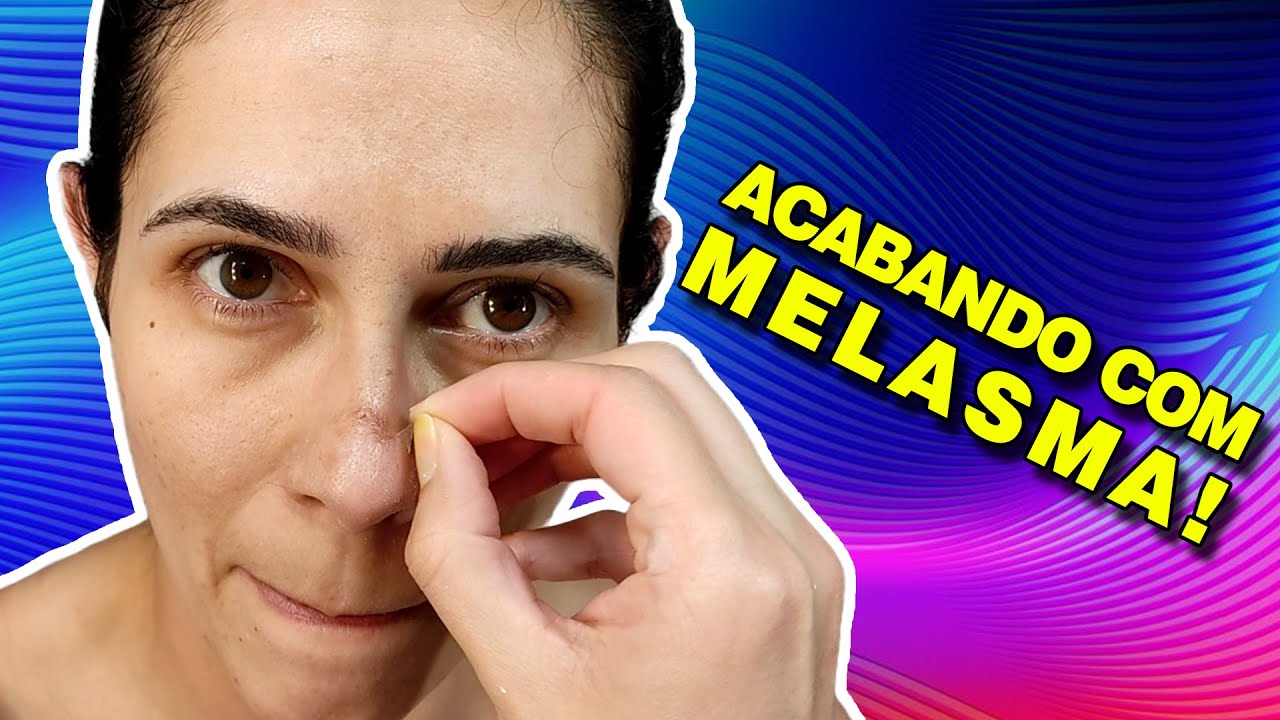 Melasma: Como Eliminei! Vitacid Plus + EPSOL = Pele Impec&aacute;vel!