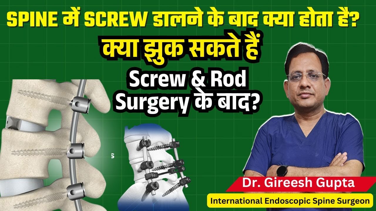 क्या रीढ़ की हड्डी में स्क्रू और रॉड लगने के बाद झुक सकते हैं? | Dr. Gireesh Gupta Explained