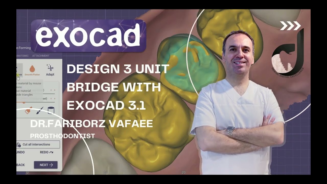 how to design 3 unit bridge with exocad3.1(part2)