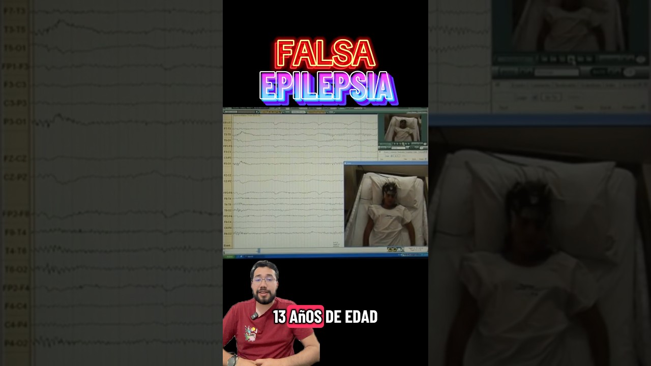 LA FALSA EPILEPSIA | &iquest;Crisis Epil&eacute;pticas o Crisis Psicogenas? Convulsiones falsas #epilepsia