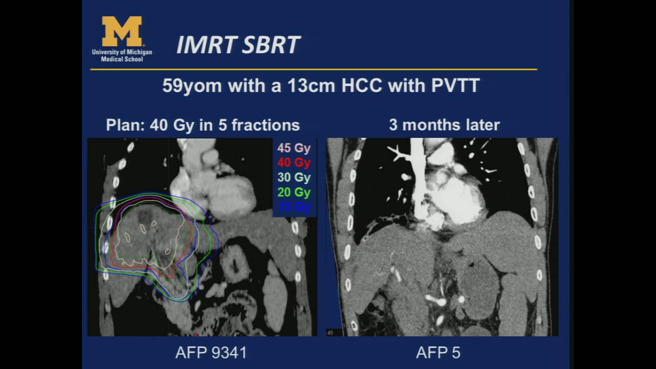SRS/SBRT -  Prostate, Pancreas & Liver - By M Matuszak Ph.D & M Feng, M.D.