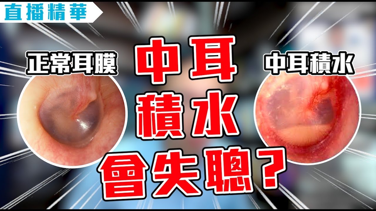 感冒一定要吸鼻涕? 不吸鼻涕會引發中耳炎嗎? | 迷思破解 | 直播精華EP4