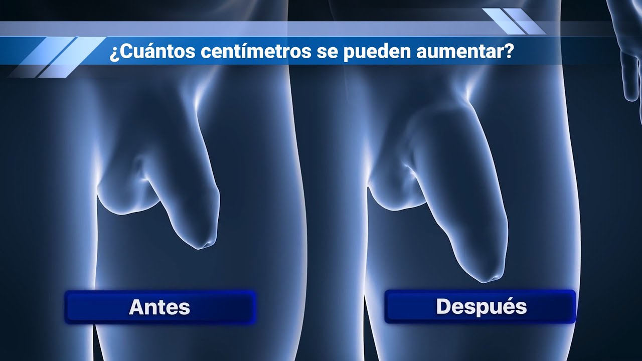 Cirug&iacute;a de Alargamiento y Engrosamiento de pene en Arequipa - Ur&oacute;logo Dr Julio Abarca