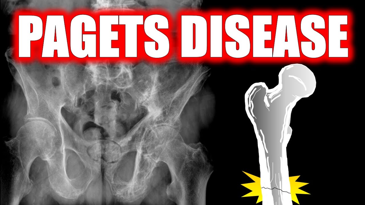 Classic X-Ray Signs of Paget&rsquo;s Disease 🦴 | Radiology Review #radiology #doctor #bones