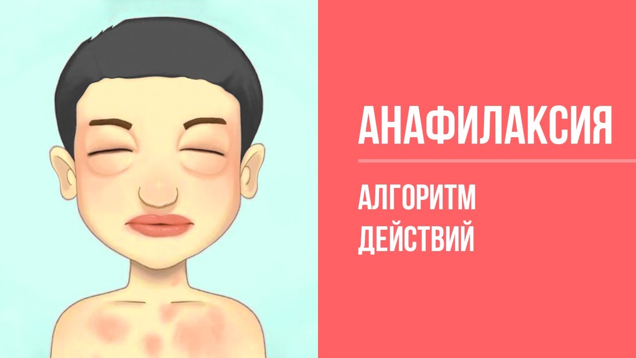 Неотложная помощь: Анафилактический шок