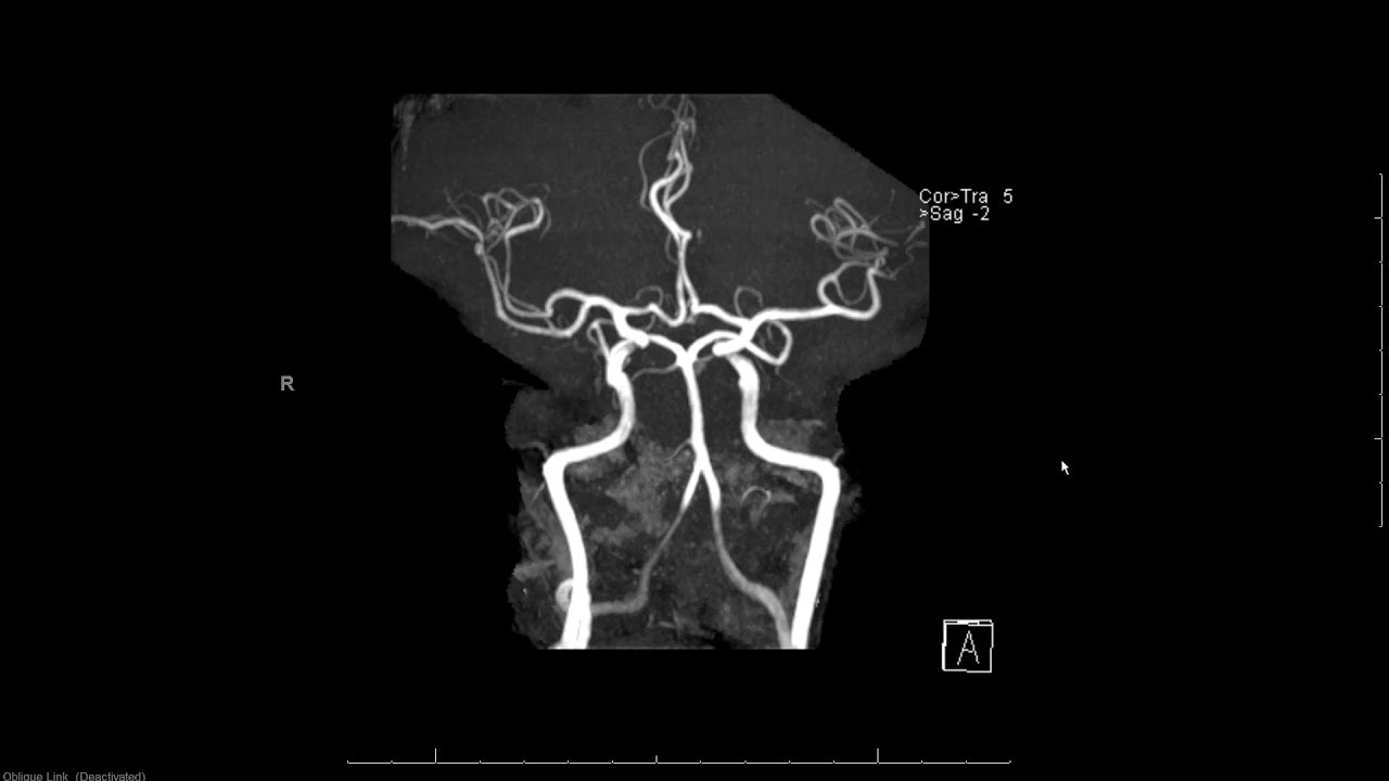 MRA (magnetic resonance angiogram) head radiology search pattern