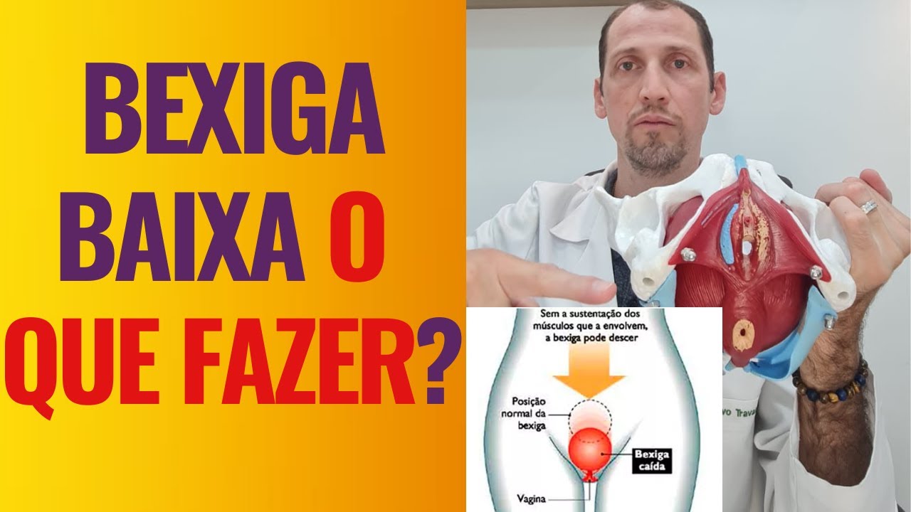 👉Bexiga baixa o que fazer?☝