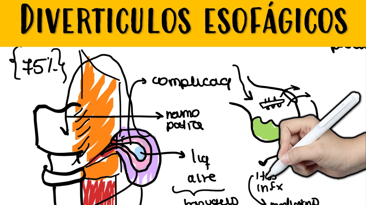 DIVERTICULOS ESOFAFICOS #Zenker #pseudodiverticulo #diverticulo #verdadero #diverticulectomia