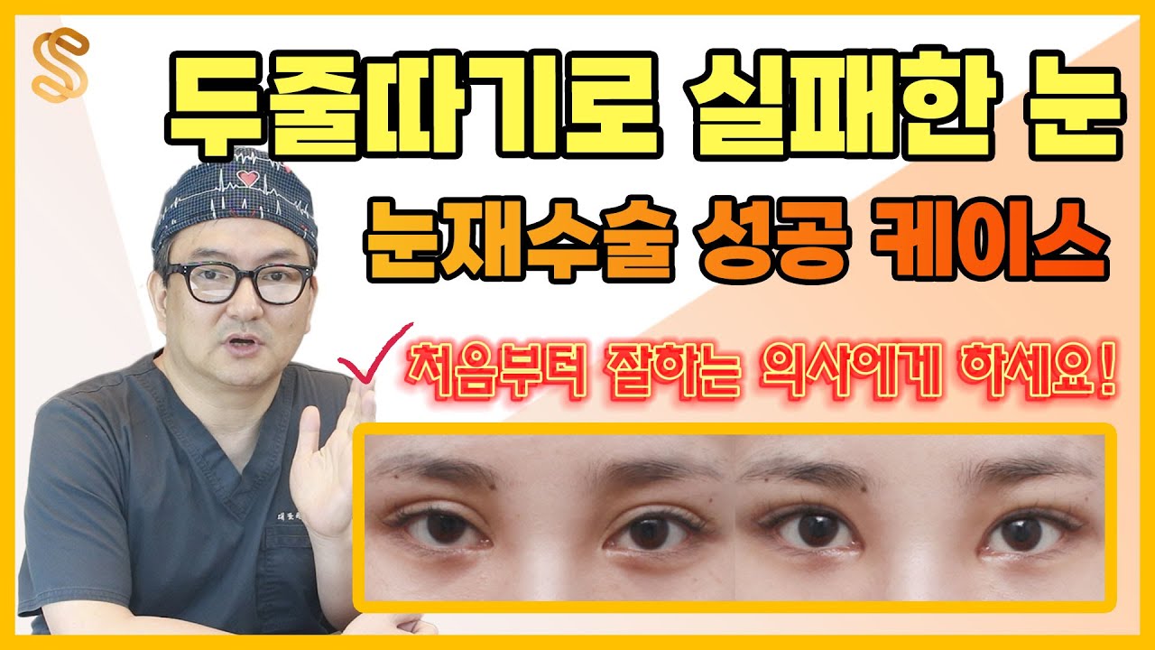 타병원에서 두줄따기 실패한 눈재수술 성공 케이스! #쌍꺼풀재수술 유명한병원 #쌍커풀재수술 잘하는곳