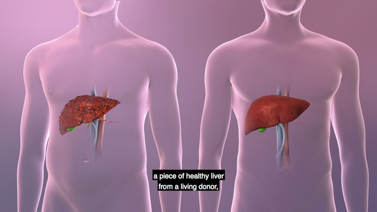 UPMC Living-Donor Liver Transplant