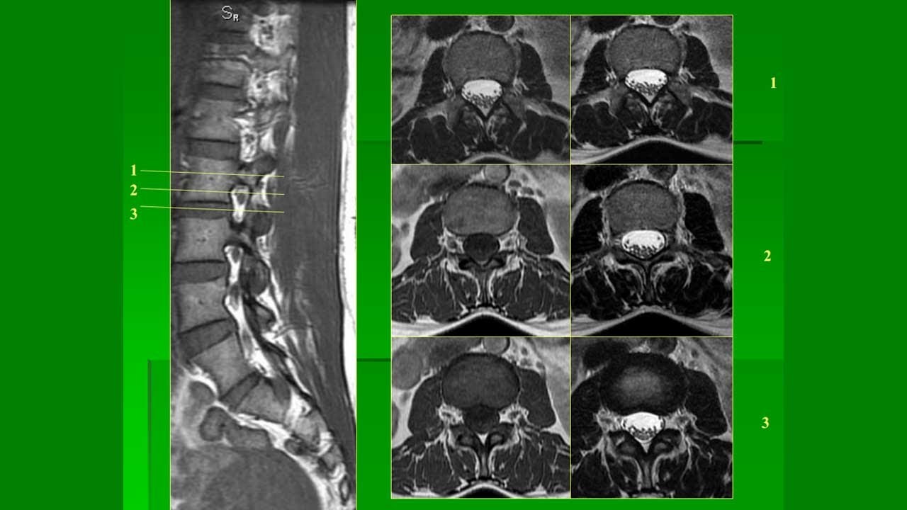 MRI Thoát vị đĩa đệm, Bs Phan Châu Hà
