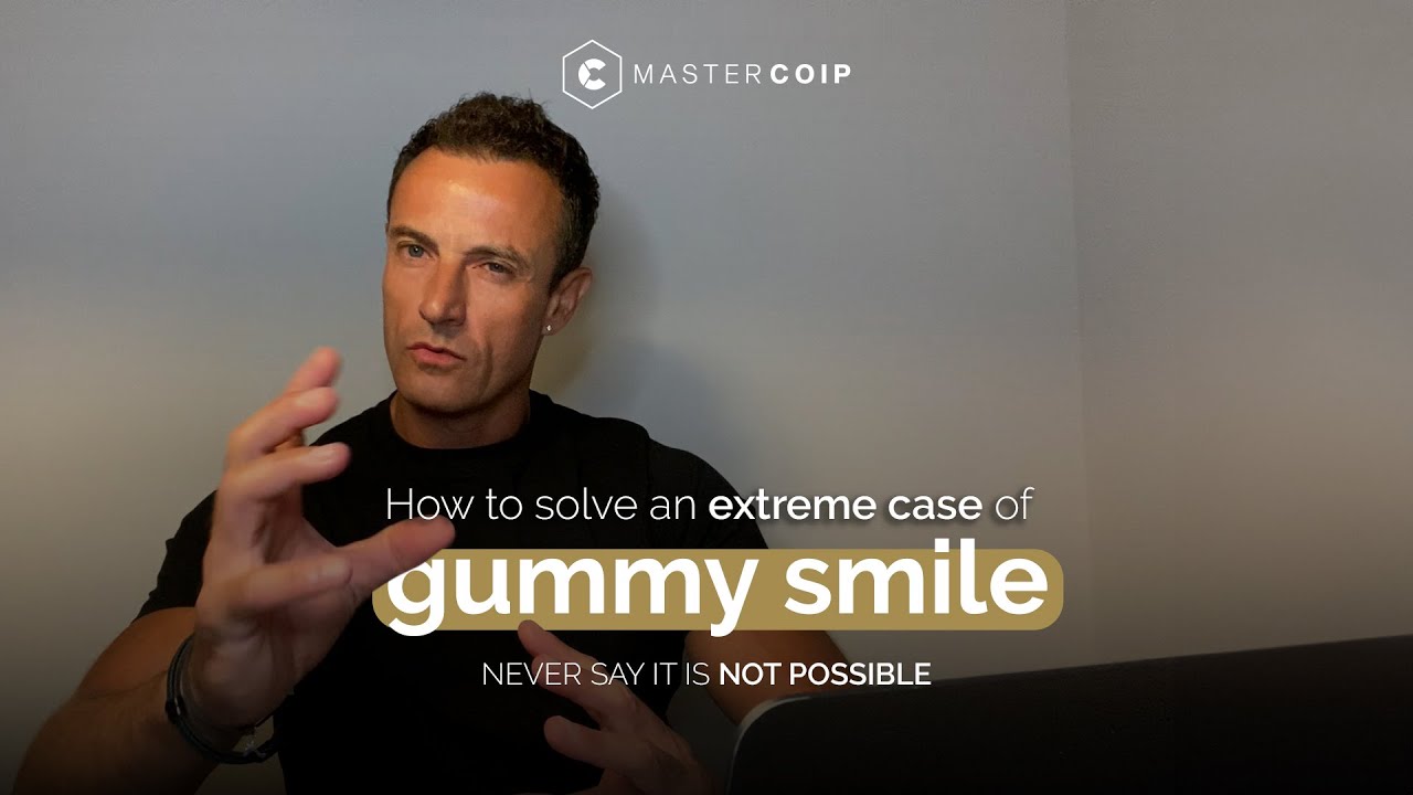 Solving a extreme GUMMY SMILE with CLEAR ALIGNERS