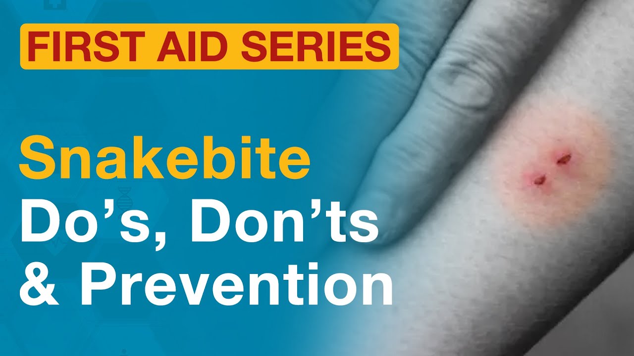 Understand snakebite, recognize the signs, learn how to provide first aid. Dr. Praveen Sodhi