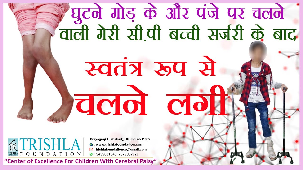 Cerebral Palsy: Role of Physical Therapy & Surgery in the Recovery of Cerebral Palsy Child