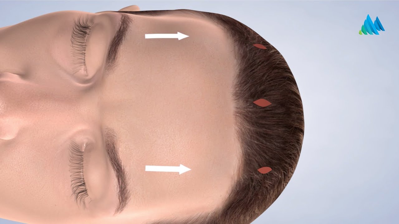 Brow Lift in Charleston WV | Mountain State Oral & Facial Surgery
