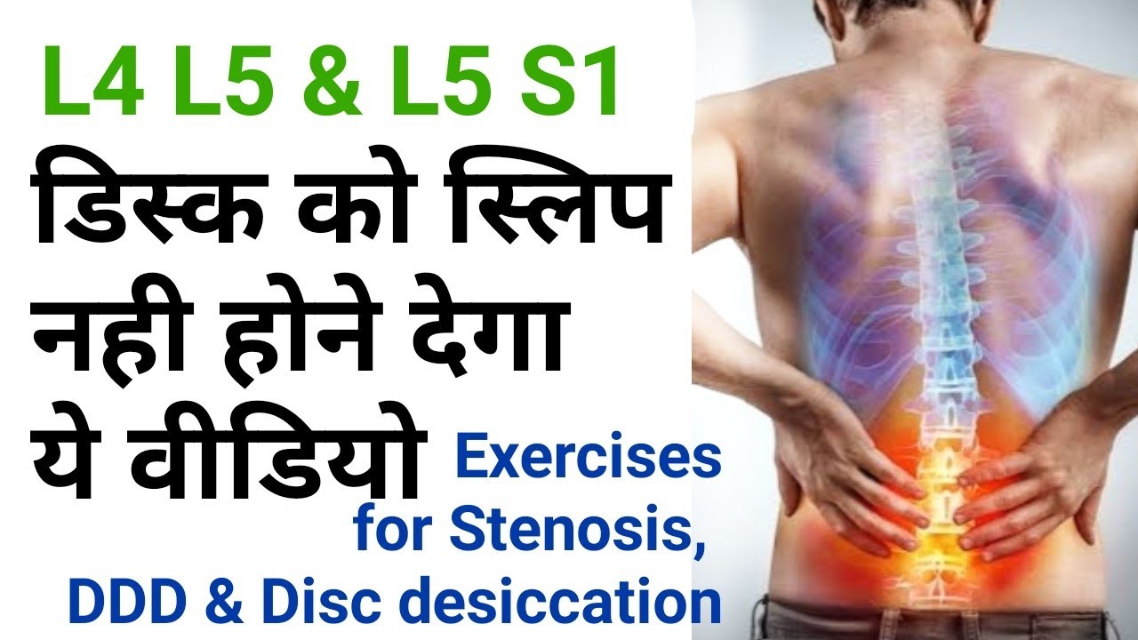 exercises for back pain, Disc Dessication, stenosis, l4l5, l5s1, facet joint  by dr sandeep Bhardwaj