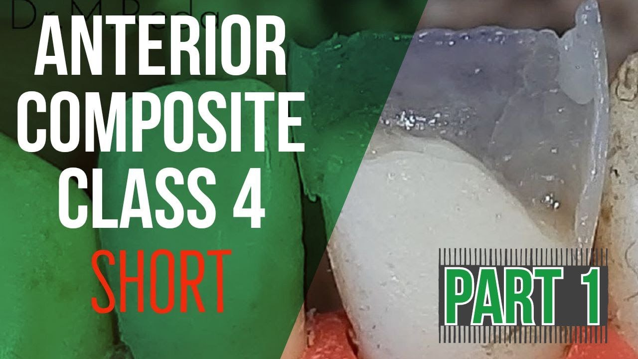 anterior composite class 4 100 tips(English)
