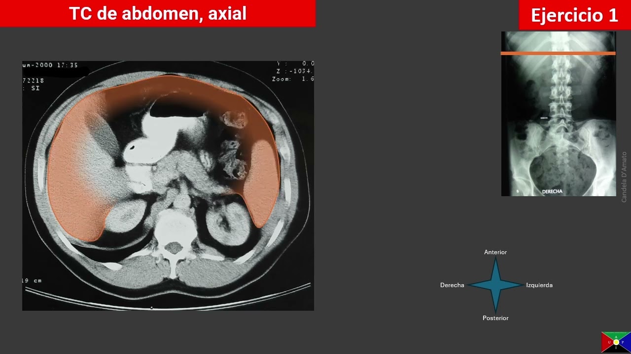 Tomografía computada de abdomen supramesocolico - parte A