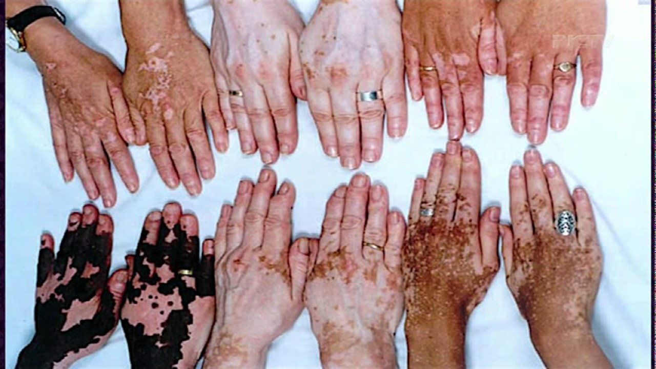 Tire suas dúvidas sobre vitiligo