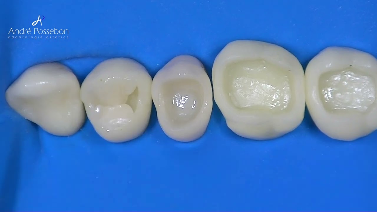 🎯 Dica #18 - Estratificação com técnica incremental do 1º pré-molar superior.