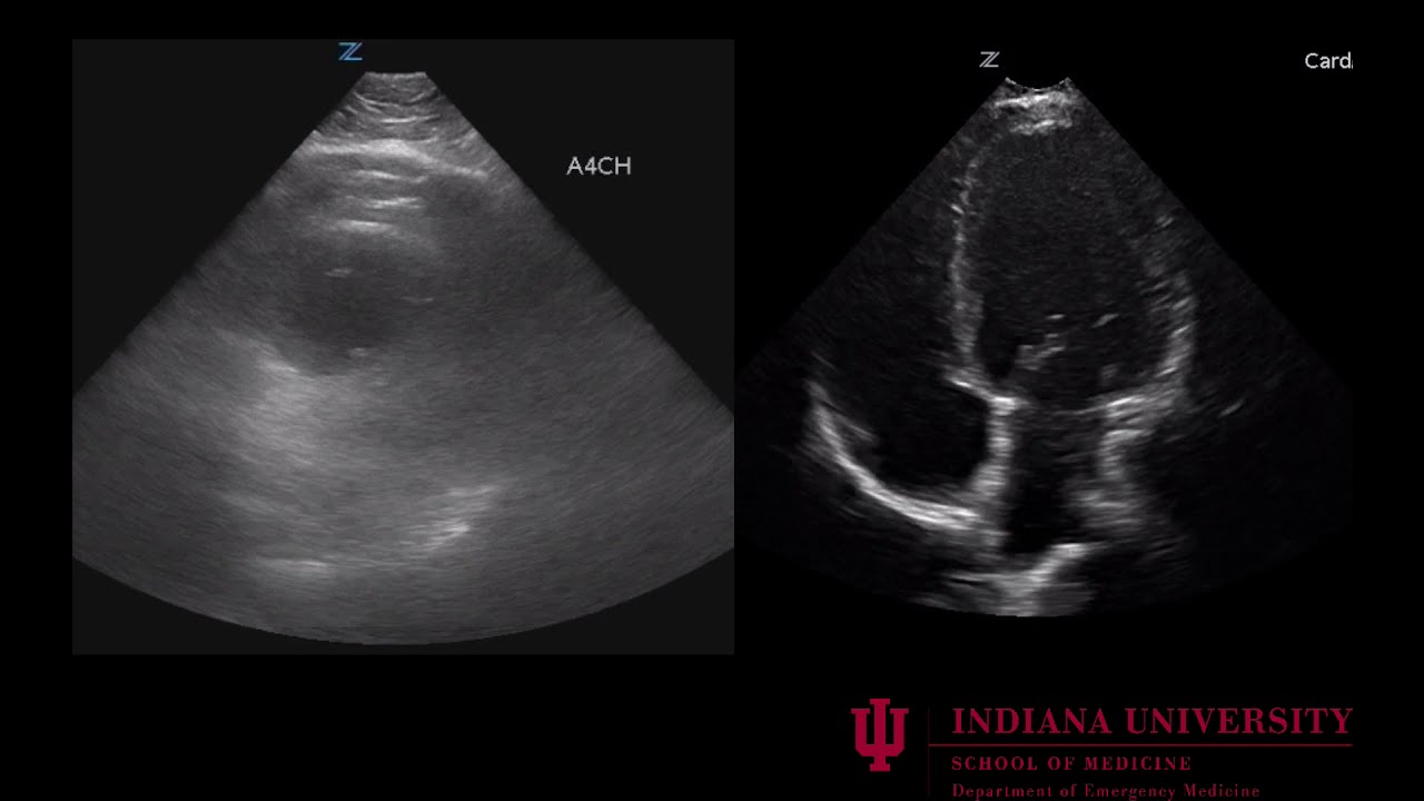 Massive Pulmonary Embolism Ultrasound: 9/2019