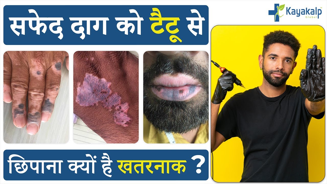 Tattoo for Vitiligo (सफेद दाग)| Vitiligo Tattoo| Vitiligo Tattoo Treatment in Delhi| Kayakalp Global