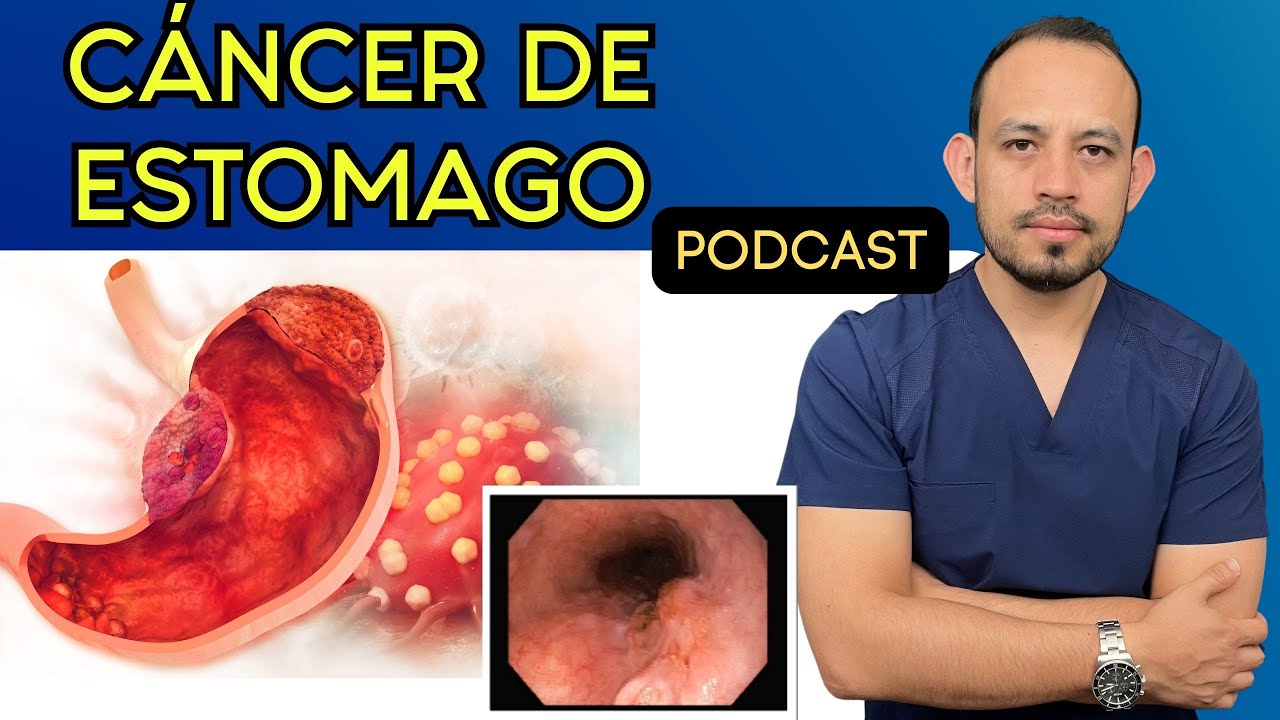 🍤  𝗖𝗔́𝗡𝗖𝗘𝗥 𝗚𝗔́𝗦𝗧𝗥𝗜𝗖𝗢: 𝗦𝗜́𝗡𝗧𝗢𝗠𝗔𝗦, Causas, Diagnóstico y Tratamiento | Dr. Christian Cruz Cx Oncólogo