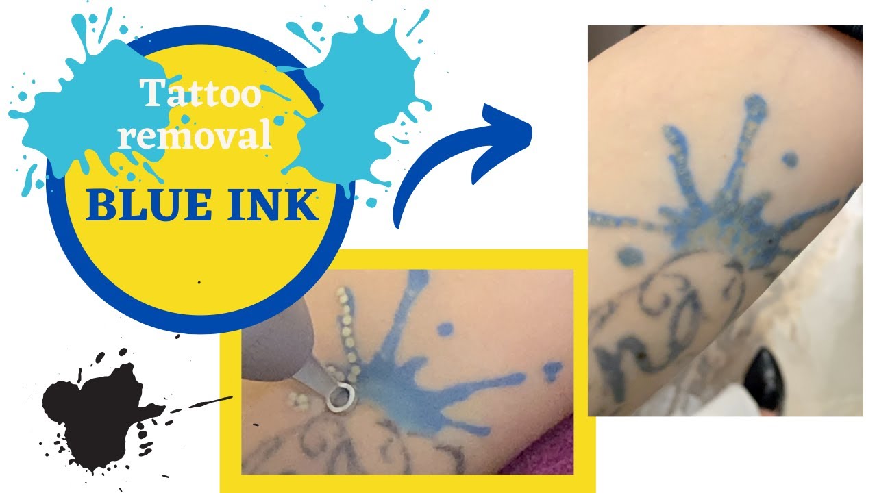Tattoo Removal using Picoway  👍🏼[Blue Ink 1 week results ]😍