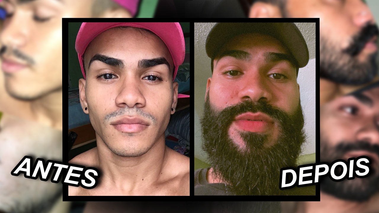 EVOLUÇÃO COM MINOXIDIL - 2 ANOS DE TRATAMENTO (Kirkland)