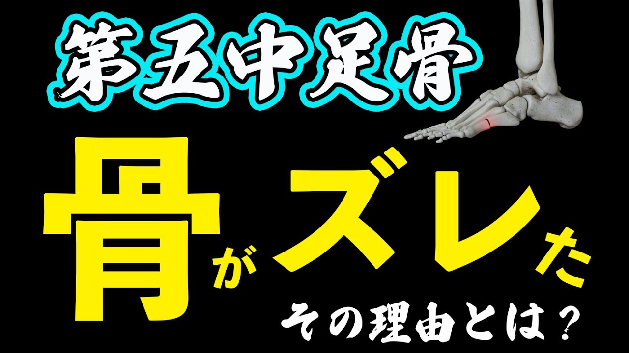 【第5中足骨骨折の方必見👀】ヒビだったのに骨がズレた？その理由とは？ #骨折 #骨折を早く治す #第5中足骨骨折 #ひび